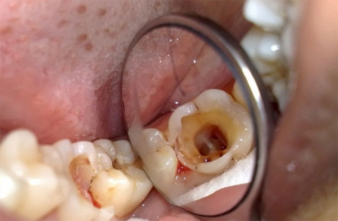 Chữa đau răng bằng tinh chất bạc hà