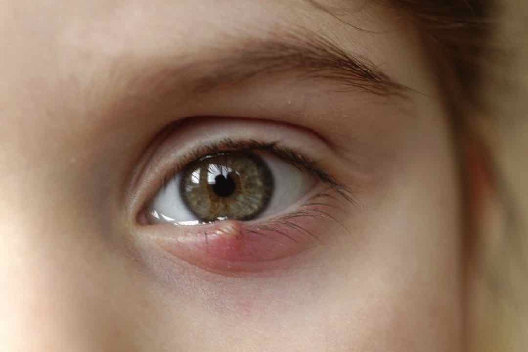 Mẹo chữa lẹo mắt chỉ có tác dụng khi sử dụng kịp thời