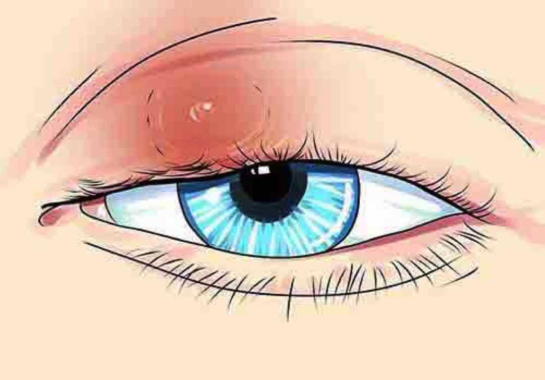 Mẹo chữa lẹo mắt giúp điều trị lẹo nhanh chóng