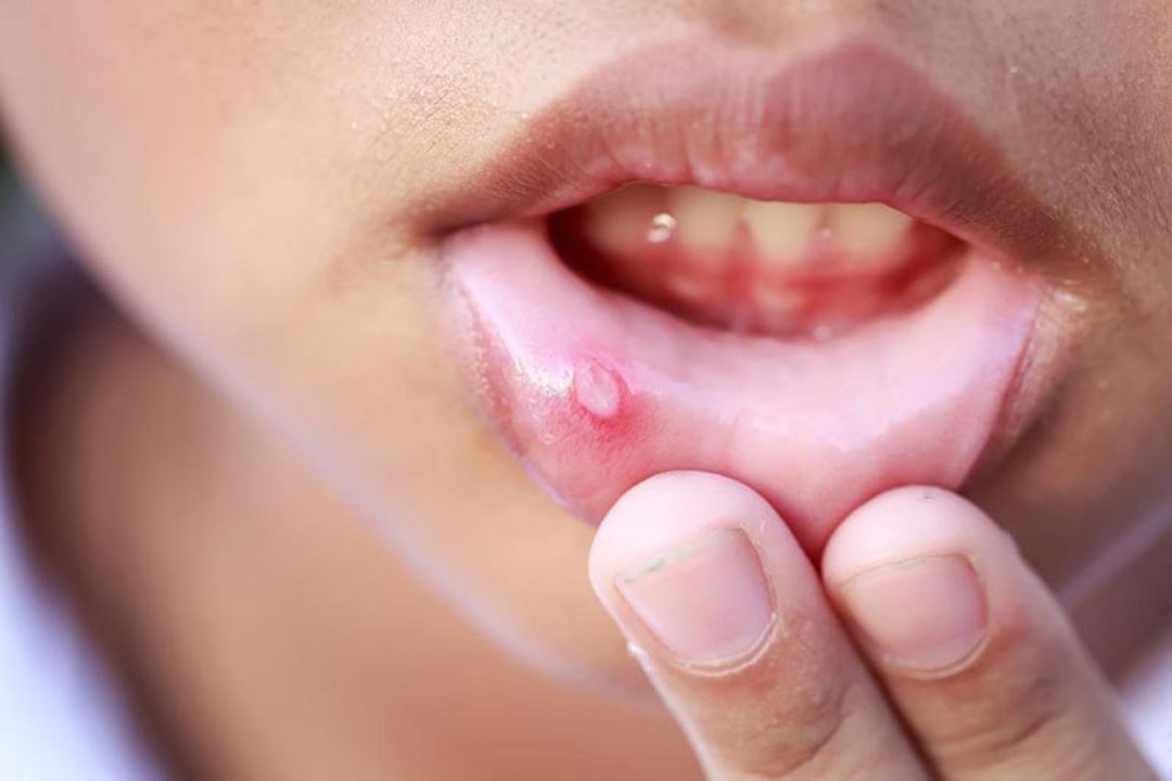 Cách chữa nhiệt miệng giúp người bệnh dễ chịu hơn 