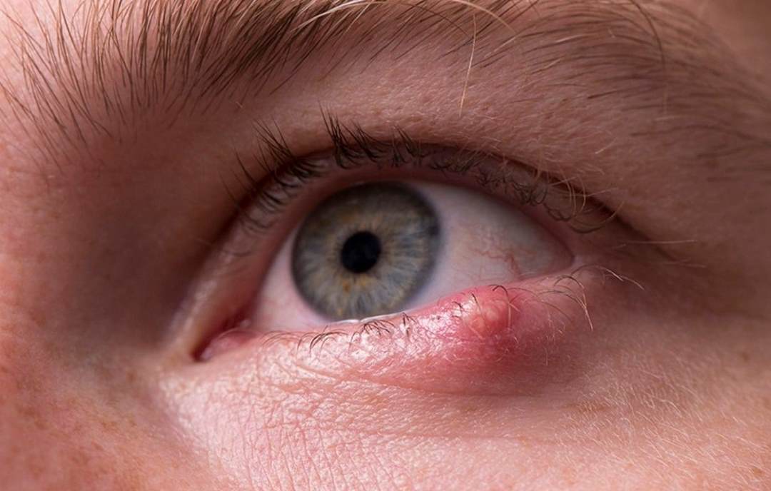 Tìm hiểu về bệnh lẹo mắt