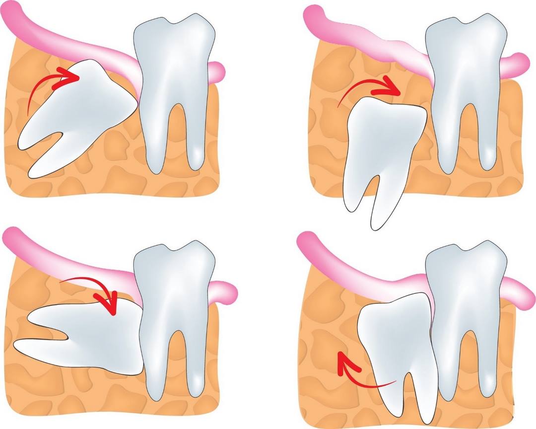 Sâu răng là là nguyên nhân gây đau răng phổ biến