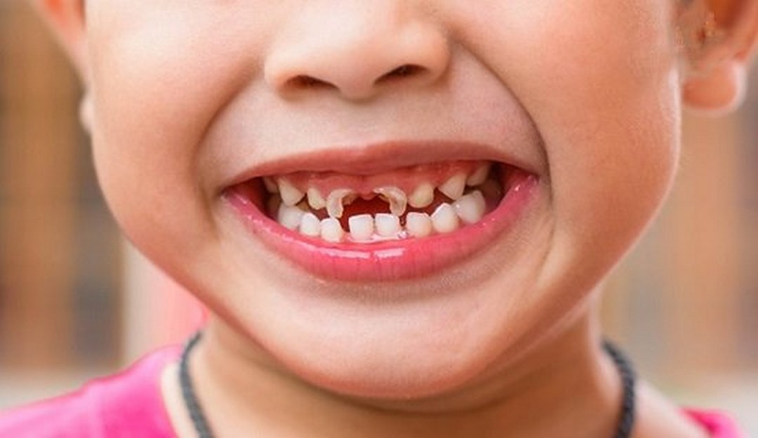 Đau răng không chỉ làm bạn khó chịu và đau đớn