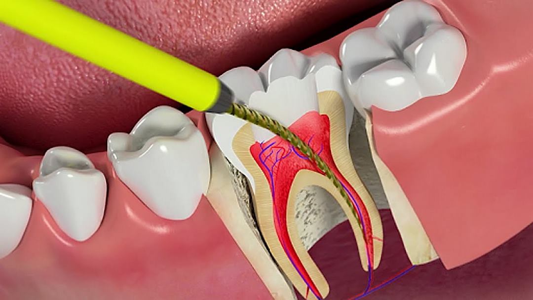 Điều trị sớm đau răng giúp giảm đau và khó chịu cho bạn