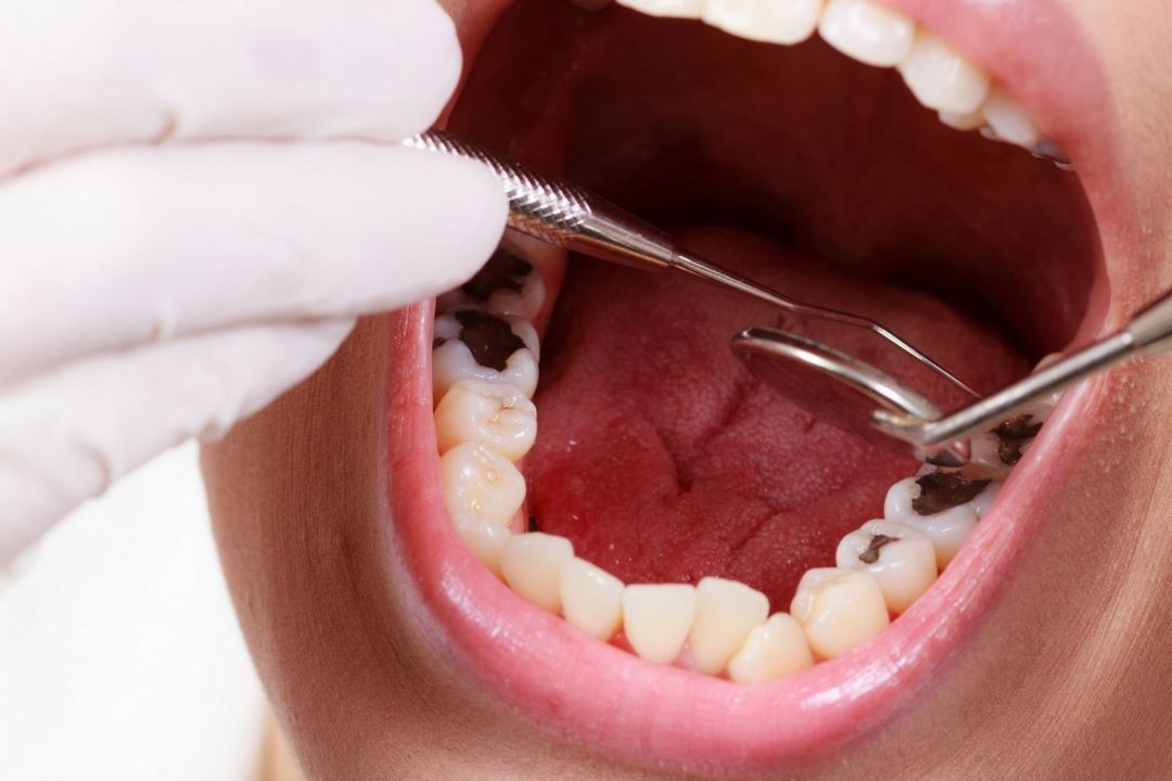 Vì sao bạn nên phát hiện và điều trị đau răng sớm?